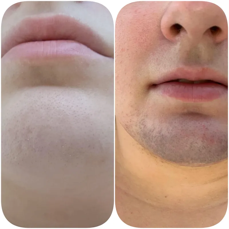 Epilare Definitiva Laser Before After Ilfov