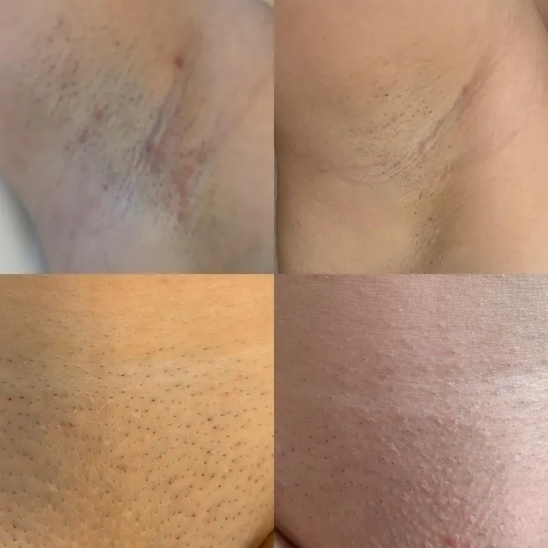 Rezultat Epilare Definitiva Salon Emirav Pantelimon