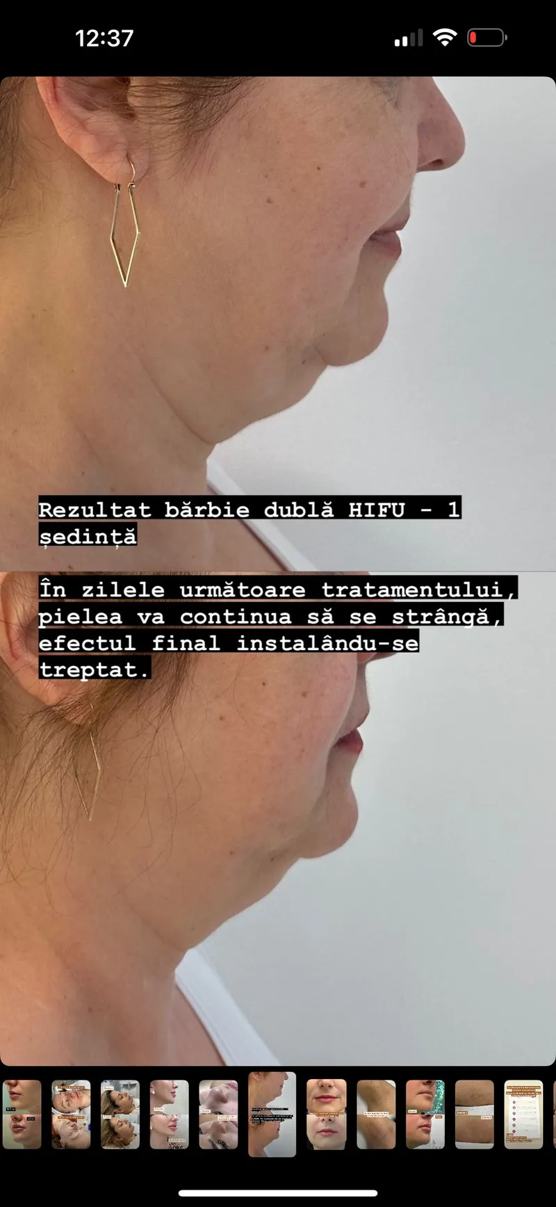 Rezultat Lifting Facial Hifu Pantelimon