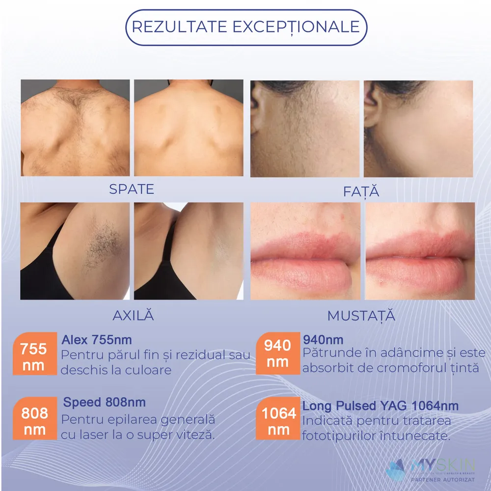 Rezultate exceptionale epilare definitiva
