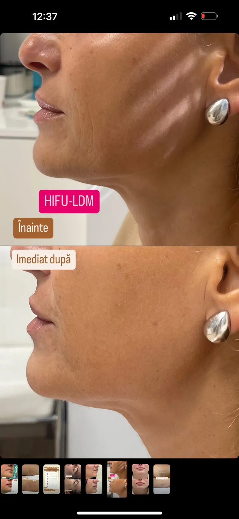 Tratament Facial Hifu Before After Salon Emirav